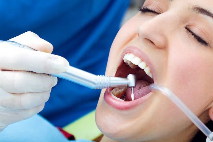 Dental Sealants Insights: Smart Advice for Better Dental Hygiene and Cavity Prevention