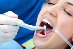 Dental Sealants Insights: Smart Advice for Better Dental Hygiene and Cavity Prevention