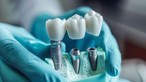 Dental Implants Guide: Essential Information for Understanding Tooth Replacement Options