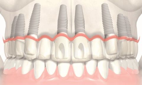 Maxillary Implant Guide: Understanding Procedures, Benefits, and Outcomes