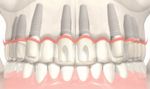 Maxillary Implant Guide: Understanding Procedures, Benefits, and Outcomes