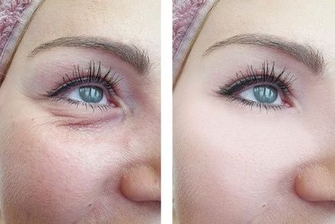 Laser Resurfacing for Eye Bags: Complete Guide to Treatment, Benefits, and Recovery