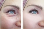 Understanding Laser Resurfacing for Eye Bags: How It Works, Benefits and Recovery