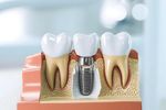 Complete Guide to Dental Implants: Procedure, Benefits, and Aftercare Tips