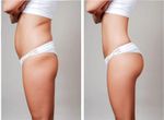 Non-Invasive Hip Lift Explained: Tips, Advice, and Practical Insights to Help Learn