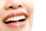 Teeth Whitening Guide: Essential Methods, Benefits, and Oral Care Information