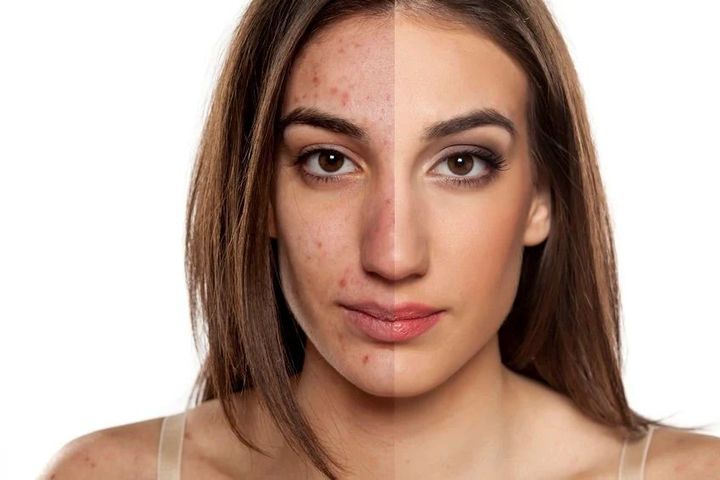 Acne Scar Removal Guide: Methods, Skin Types and Recovery