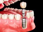 Dental Implants Guide: Procedure, Recovery & Long-Term Care